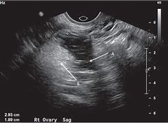 Image result for Ovarian Dermoid Cyst