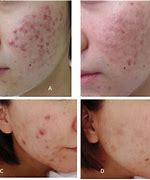 Image result for Allergic Inflammation