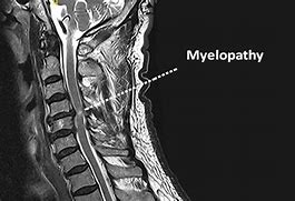 Image result for myelopathy