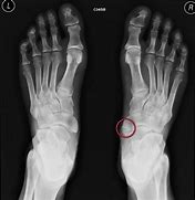 Image result for Accessory Navicular Bone Syndrome