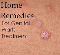 Image result for Stages of Genital Warts