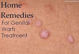 Image result for Signs of Genital Warts Disease