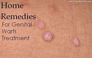 Image result for Genital Wart Removal Products