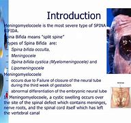 Image result for Meningomyelocele