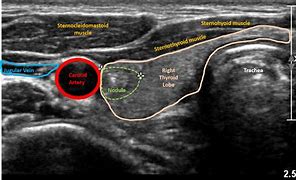 Image result for thyroid ultrasound pics