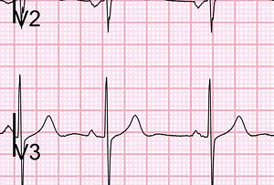 Image result for Alligator Clip to V2 On EKG