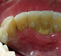 Image result for Bad Teeth and Gums