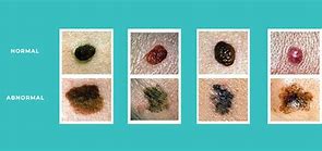 Image result for How Big Is 6Mm Tumor