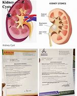 Image result for Renal Cyst Treatment