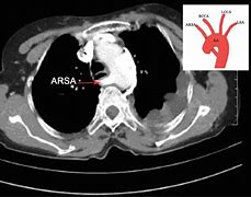 Image result for Subclavian Artery CT