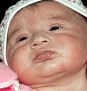 Image result for Atopic Dermatitis Baby