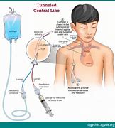 Image result for Tunneled Power PICC Line