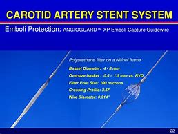 Image result for Carotid Artery Stent