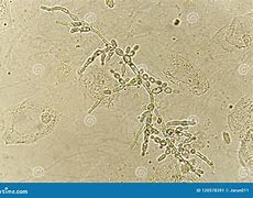 Image result for Pseudohyphae in Urine