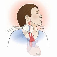 Image result for Carotid Doppler Ultrasound