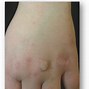 Image result for Skin Tag vs Wart Pictures