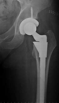 Image result for What Does a New Hip Replacement Look Like