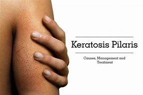 Image result for Keratosis Pilaris Laser Treatment