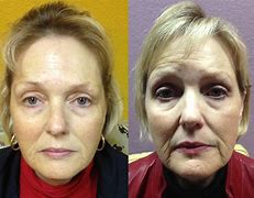 Image result for Acupuncture Face Lifting