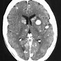 Image result for Brain Tumor Pathophysiology