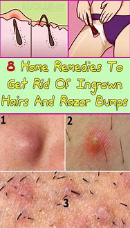 Image result for Genital Wart or Ingrown Hair