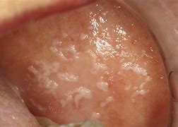 Image result for Pseudomembranous Candidiasis
