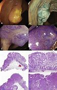 Image result for Serrated Polyp