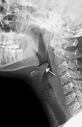 Image result for Thumbprint Sign Epiglottitis