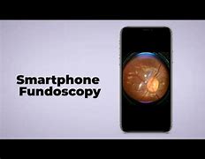 Image result for Top 5 Smartphone Funduscopy