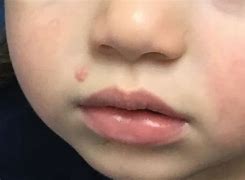 Image result for Molluscum On Face Child