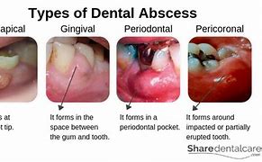 Image result for Abscesses of the Periodontium