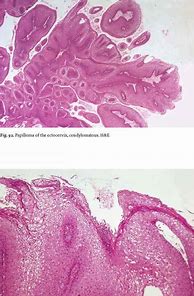 Image result for Verrucous Papilloma