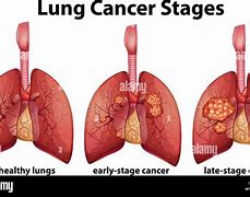 Image result for Sketchy Path Lung Cancer