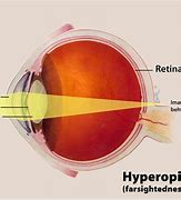 Image result for Farsighted Eye