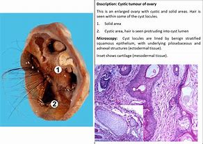 Image result for What Is a Teratoma Tumor