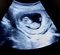 Image result for 11 Weeks 2 Days Ultrasound