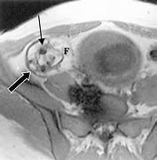 Image result for Ovarian Teratoma Tumors