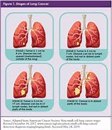Image result for Small Cell Lung Cancer Types