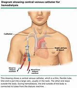 Image result for Central Venous Catheter Dialysis