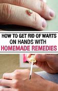 Image result for How to Treat Warts