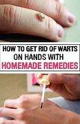 Image result for Plantar Wart Removal Hand