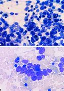 Image result for Carcinoid Cytology