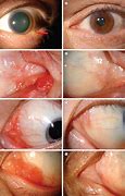 Image result for Sessile Conjunctival Papilloma