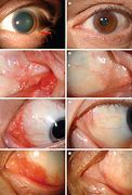 Image result for Caruncle Papilloma
