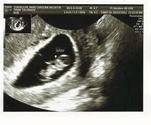 Image result for Ultrasound at 8 Weeks