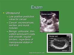 Image result for Ovarian Cancer vs Benign Cyst