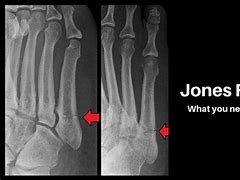 Image result for Jones Fracture Scar