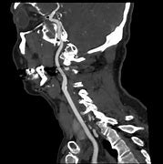 Image result for Carotid Artery CT Scan