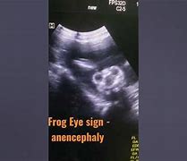 Image result for Anencephaly Frog