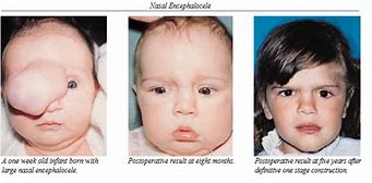 Image result for Encephalocele Before and After